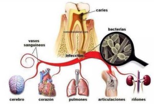 Afectación en el organismo de las infecciones bucodentales