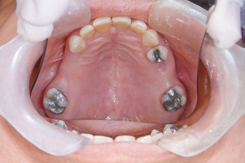 Tratamientos para dientes picados - Carlos Saiz Smile