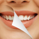 Blanqueamiento dental: ¿en casa o en la clínica? ¿cuál es mejor?