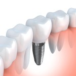 ¿Qué implante dental necesito? ¿Son todos los implantes dentales iguales?