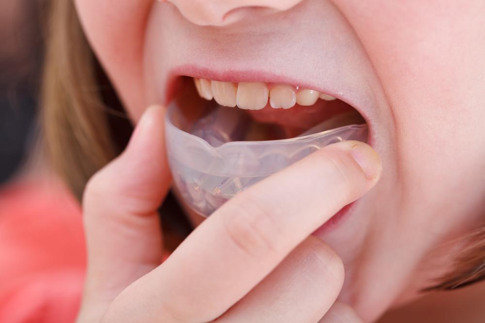 Férula Dental Brrnoo para Corregir Dientes Irregulares y Proteger