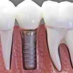 Mitos y leyendas de los implantes dentales