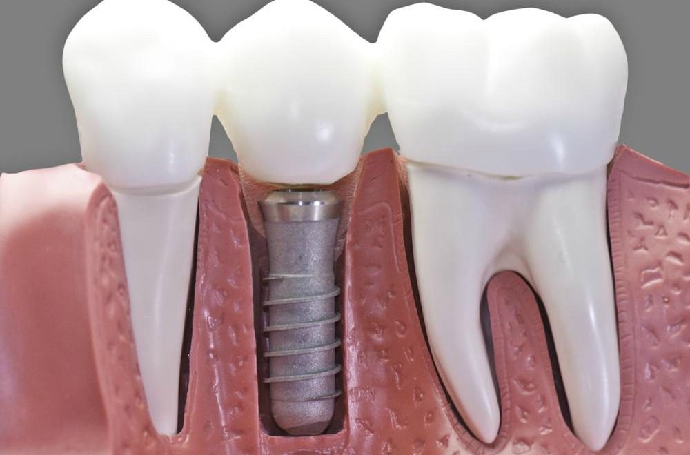 IMPLANTES DENTALES