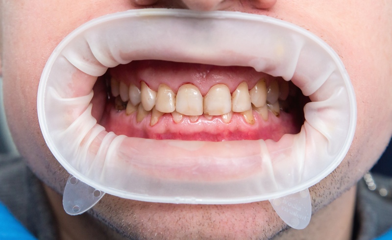 ¿Que es la fluorosis dental?