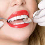 Las carillas dentales, una buena solución estética