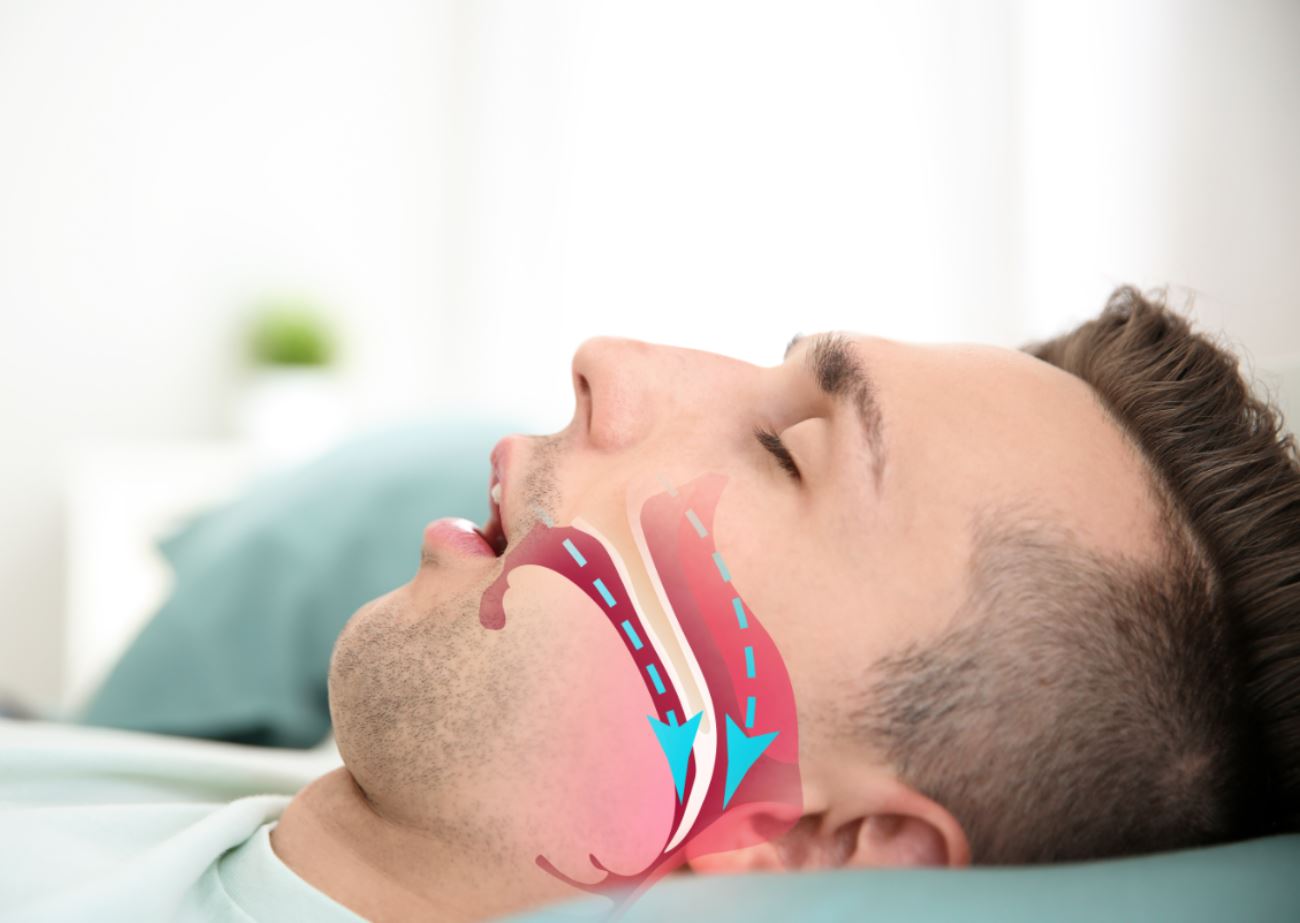 Apnea del sueño: tratamiento con férulas de avance mandibular