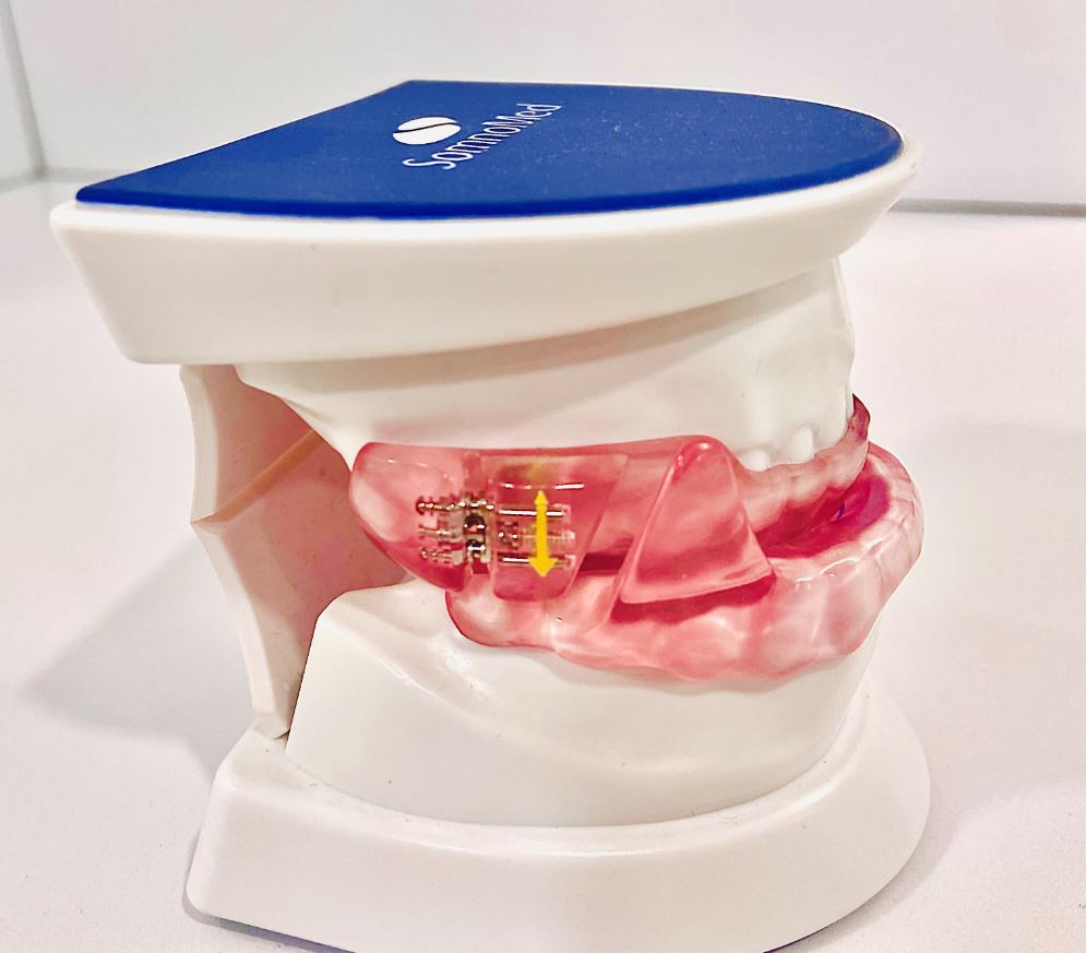 Dispositivo de avance mandibular - Centro Dental Archena