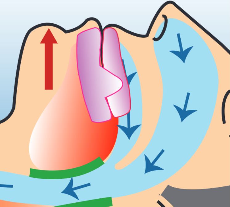 Dispositivos de avance mandibular en la apnea obstructiva del