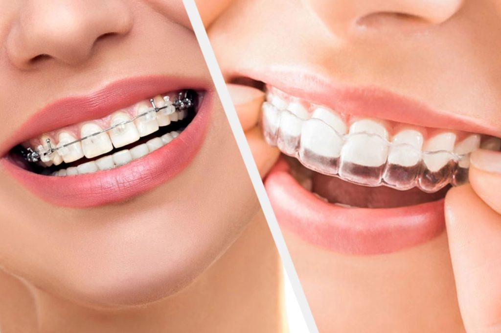 Ortodoncia tradicional y ortodoncia invisible