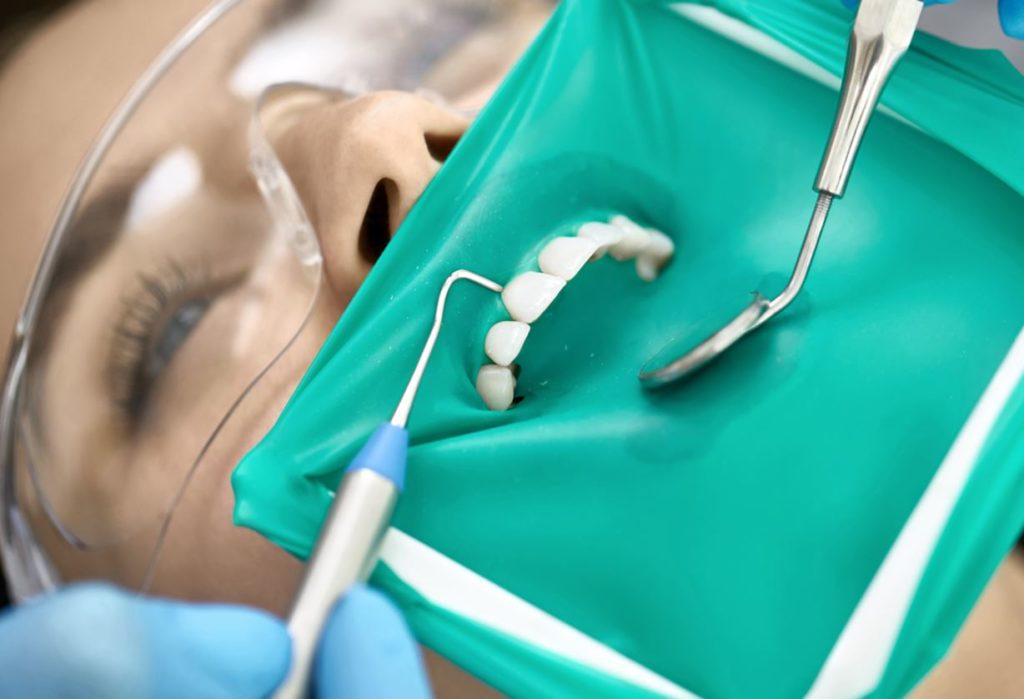 En las endodoncias se utiliza el dique dental