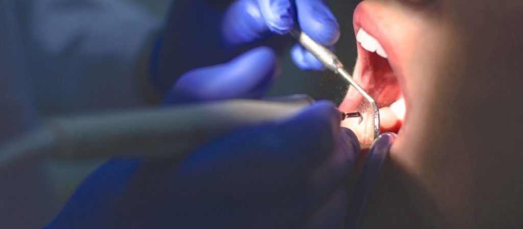 El endodoncista debe quitar la pulpa enferma o muerta