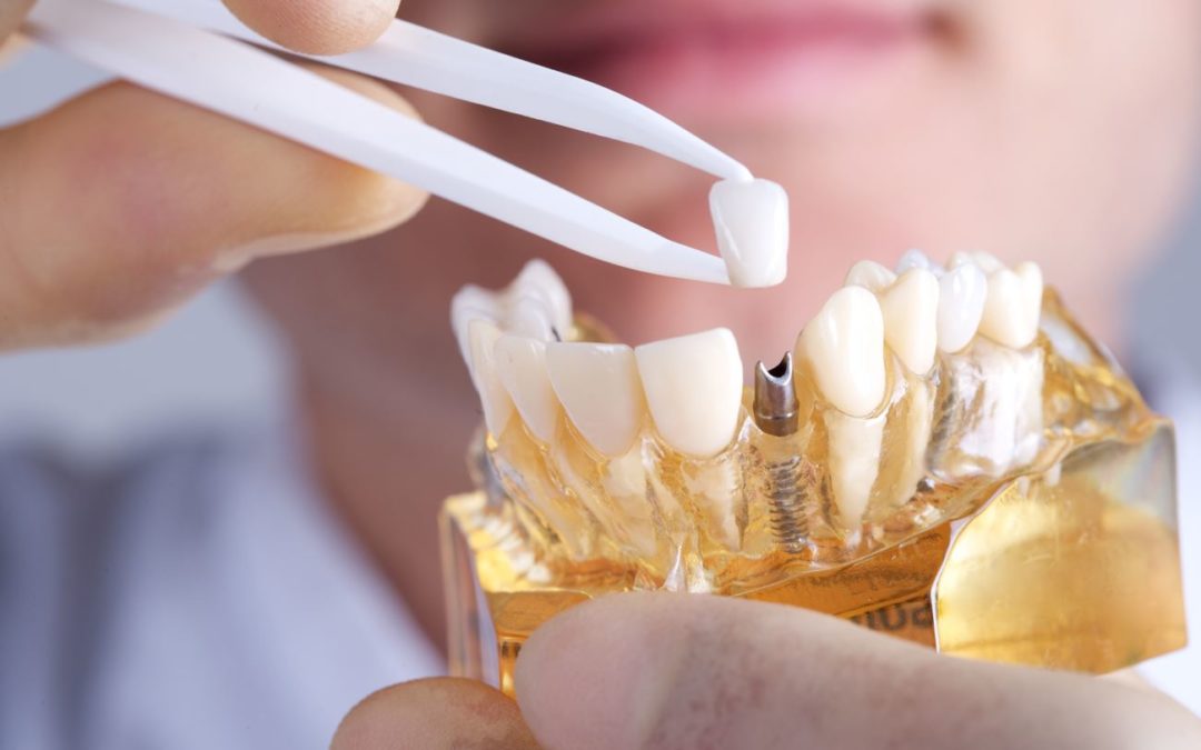 Ventajas estéticas de los implantes dentales