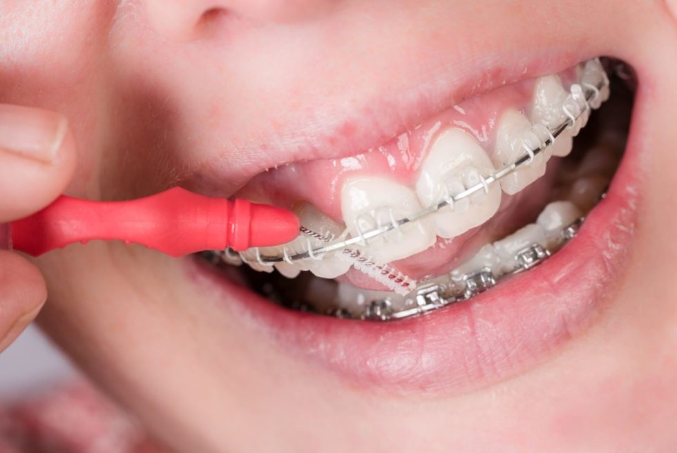 Invisalign vs brackets qué ortodoncia elegir