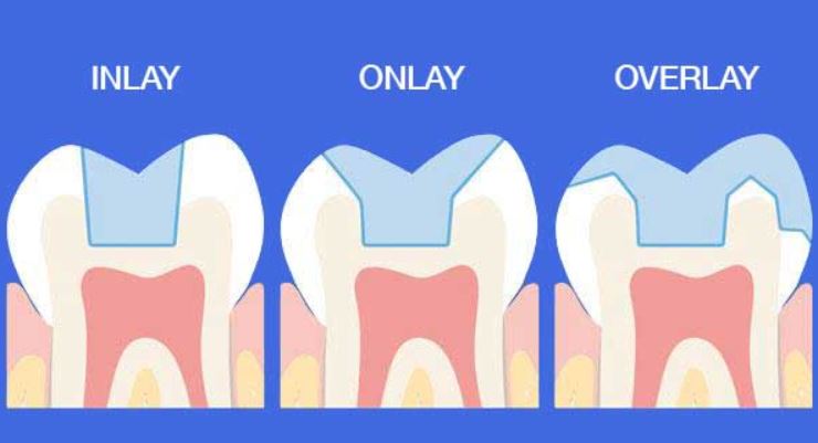 ¿Qué Es Una Incrustación Dental?