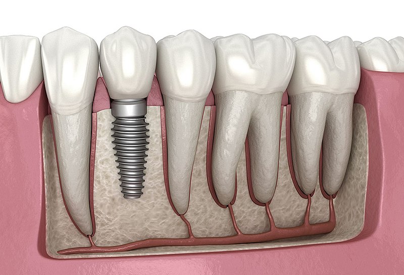 Cómo saber si tengo suficiente hueso para un implante dental?