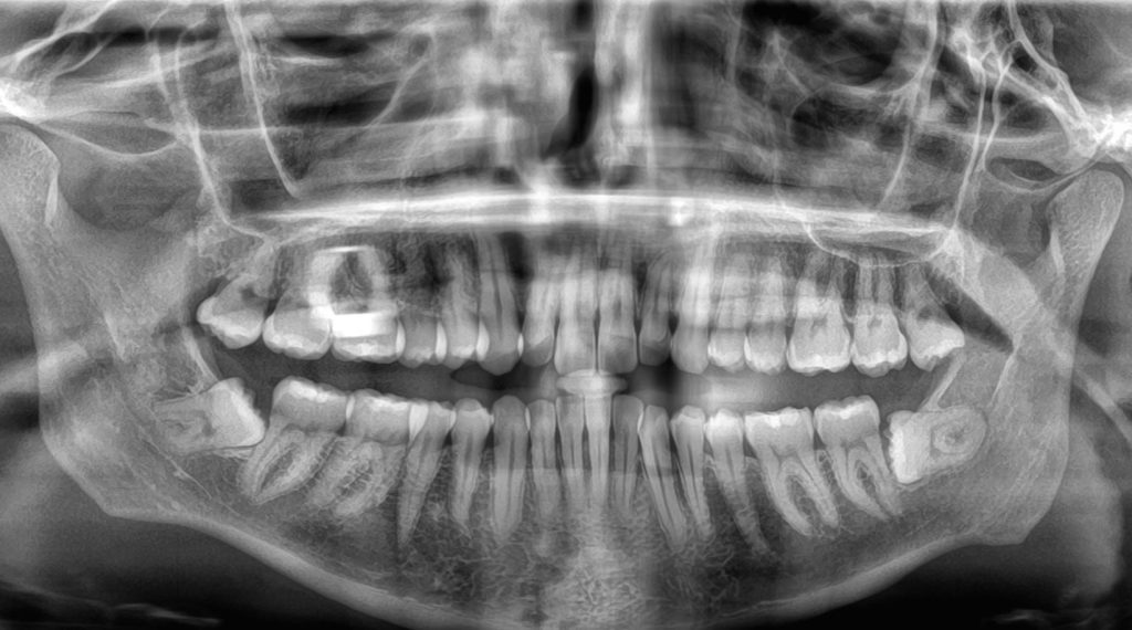 Radiografía en que se observan terceros molares retenidos en la parte inferior de la boca