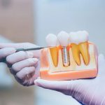 Si fumo, ¿puedo colocarme implantes dentales?