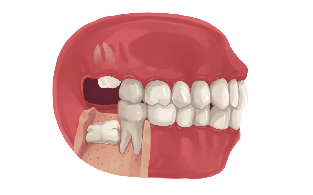 Dientes impactados: entendiendo su origen, síntomas y tratamientos