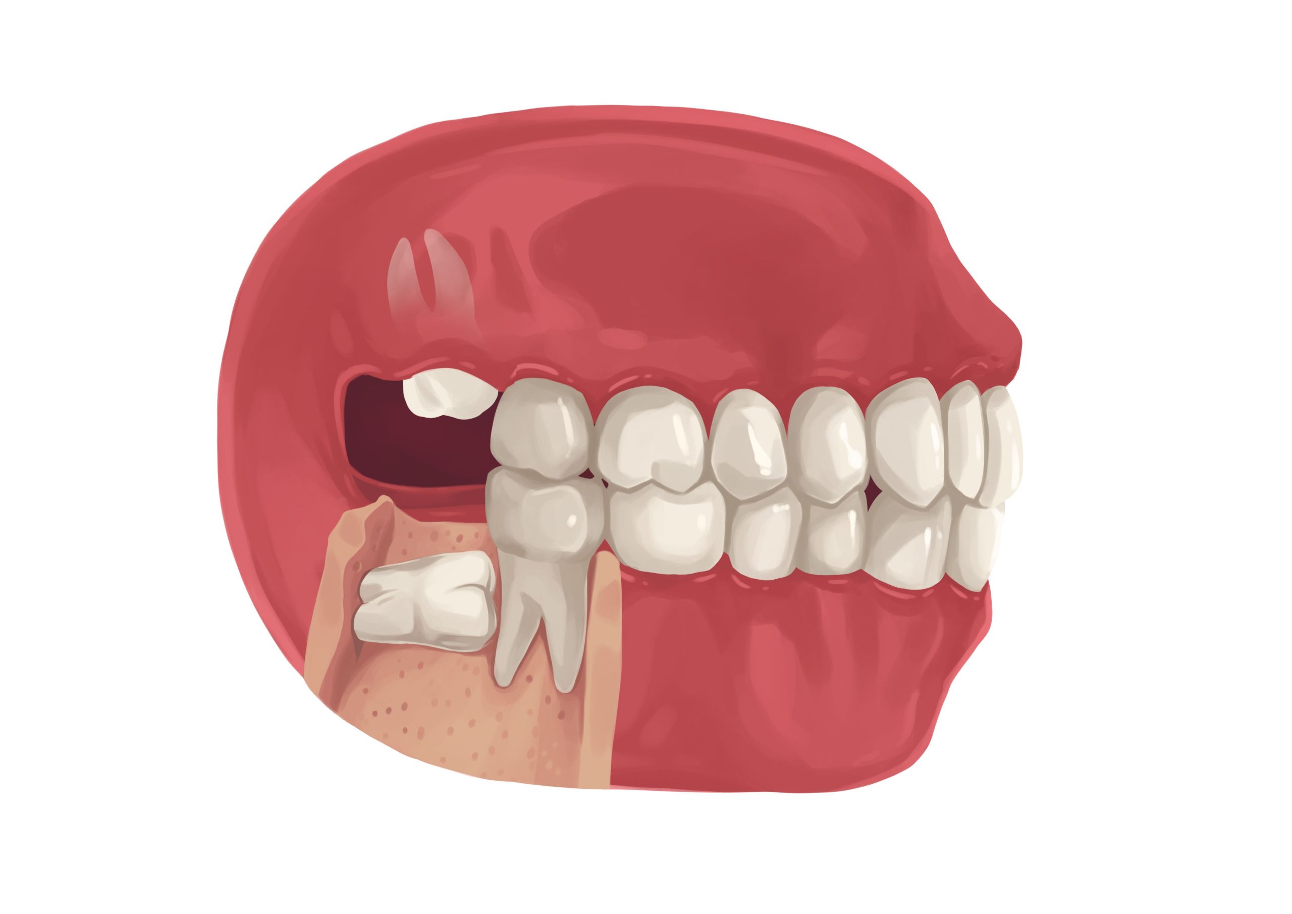 dientes imapctados