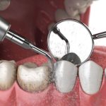 ¿Para qué sirve la limpieza dental?