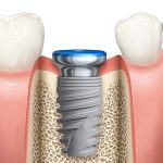 Implantes dentales: la mejor solución para la pérdida de dientes y recuperar tu sonrisa