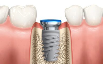 Implantes dentales: la mejor solución para la pérdida de dientes y recuperar tu sonrisa