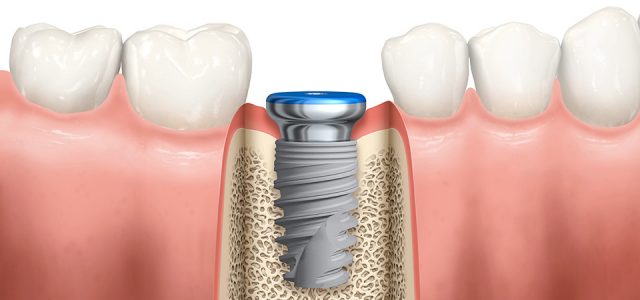 Implantes dentales: la mejor solución para la pérdida de dientes y recuperar tu sonrisa