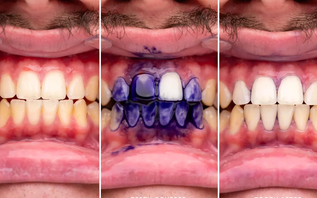 Sérums violetas para blanquear dientes: ¿Qué hay detrás de la tendencia?