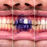 Sérums violetas para blanquear dientes: ¿Qué hay detrás de la tendencia?